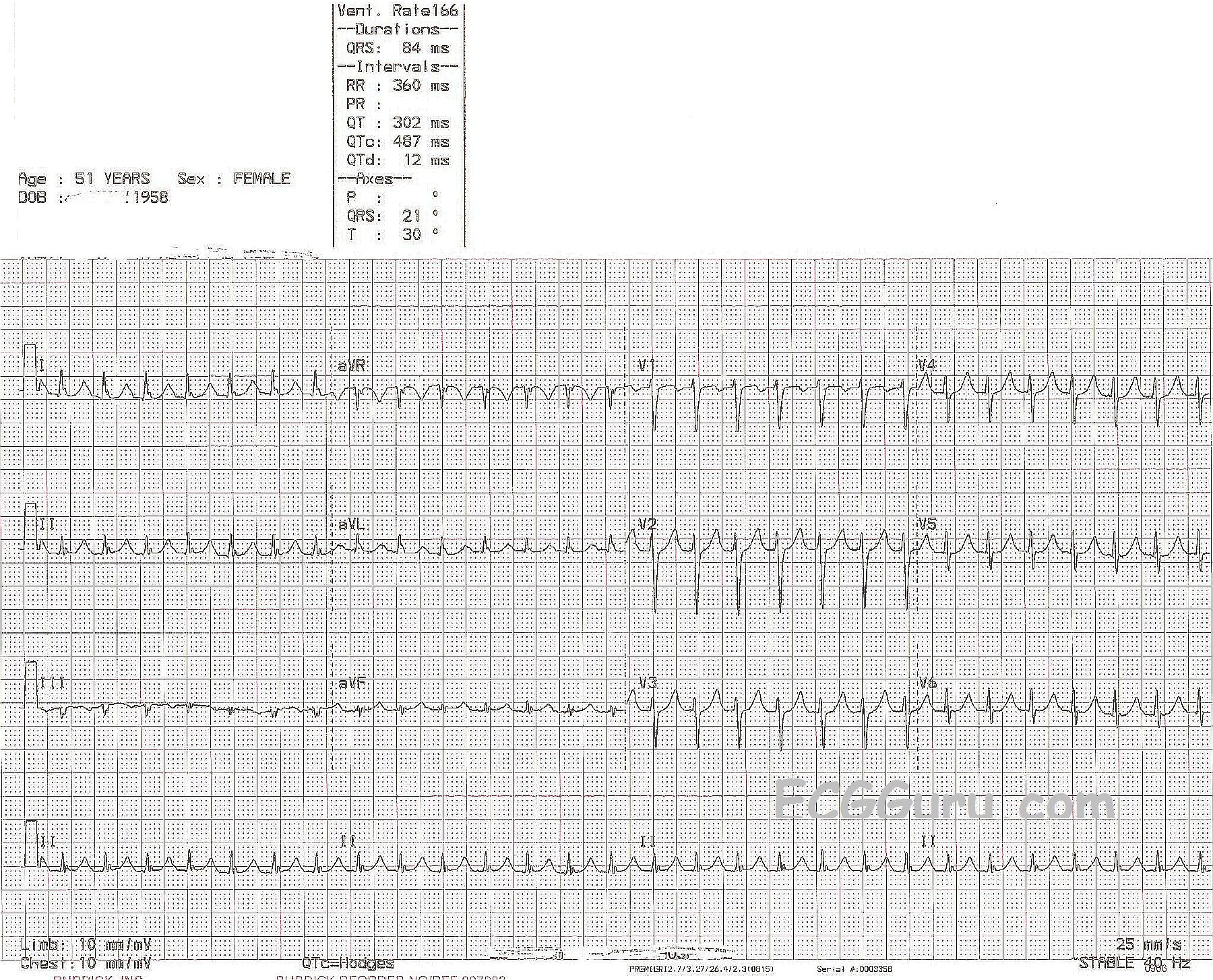 Supraventricular Tachycardia | ECG Guru - Instructor Resources